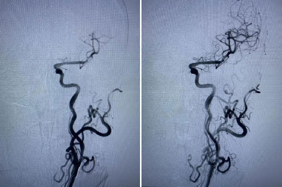 Angiography-after-stent-liberation.jpg
